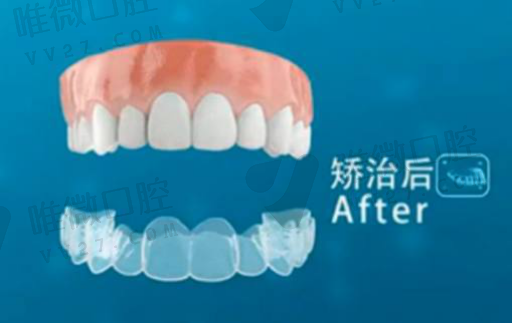 自锁牙套矫正原理（自锁牙套是怎改变牙齿的）(图1)